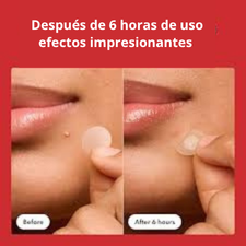 Parches Acné Espinillas Mighty Patch - Reduce imperfecciones y protege tu piel mientras actúa rápido