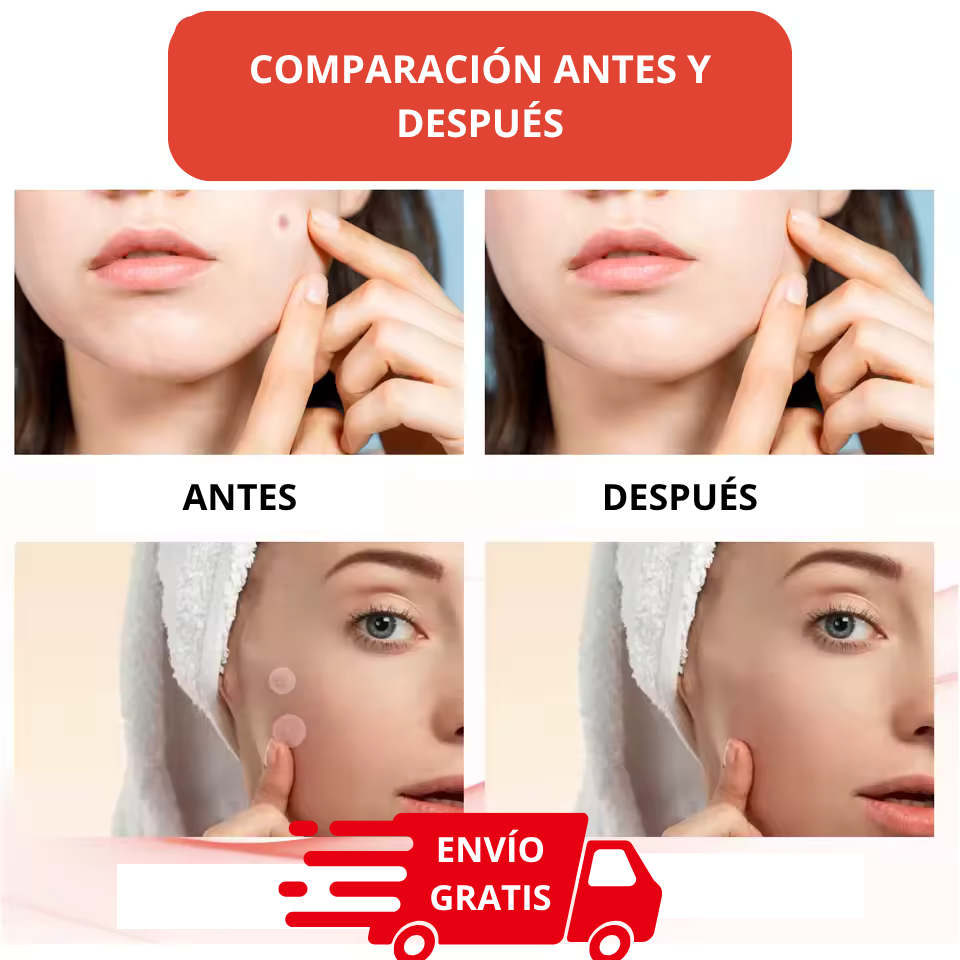 Parches Acné Espinillas Mighty Patch - Reduce imperfecciones y protege tu piel mientras actúa rápido